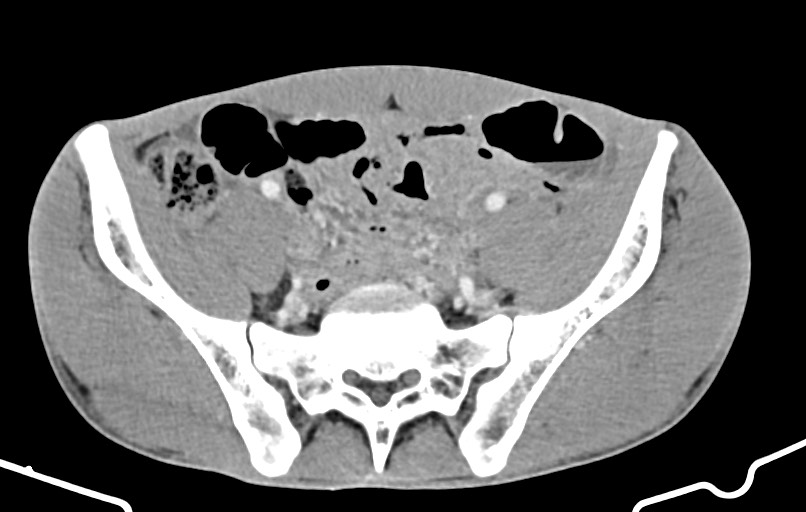 Blunt injury to the small bowel (Radiopaedia 74953-85987 A 147).jpg