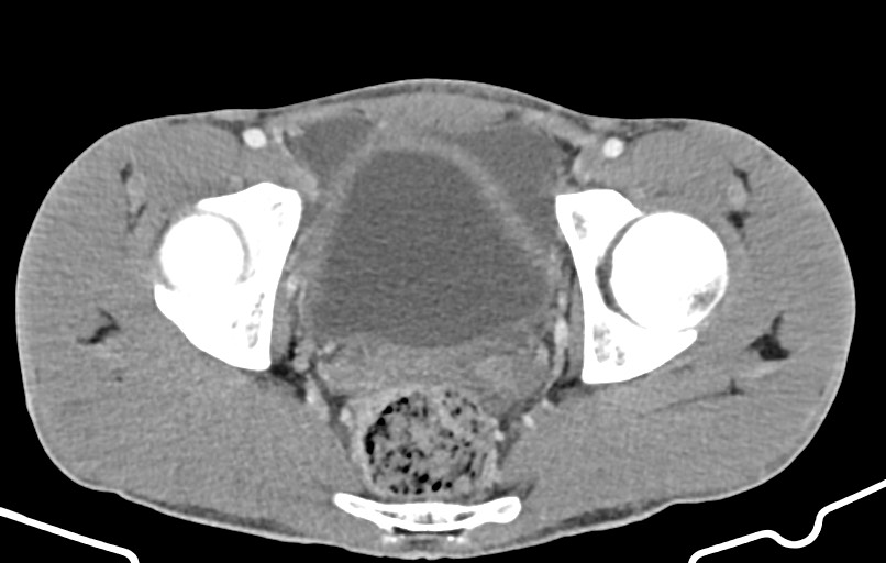 Blunt injury to the small bowel (Radiopaedia 74953-85987 A 177).jpg