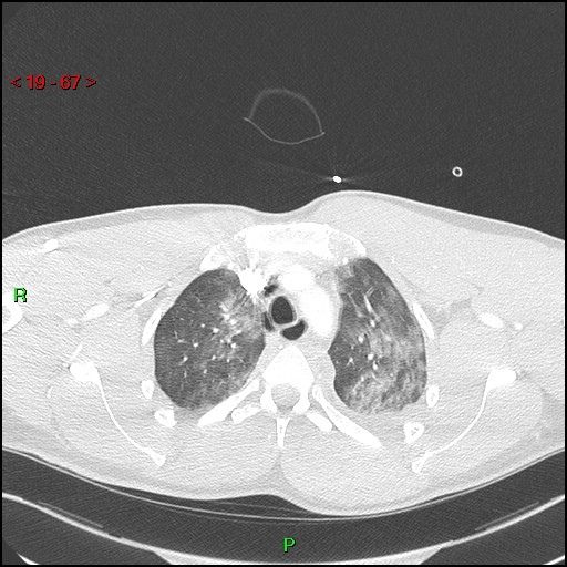 Blunt thoracic trauma (Radiopaedia 73454-84221 Axial lung window 25).jpg