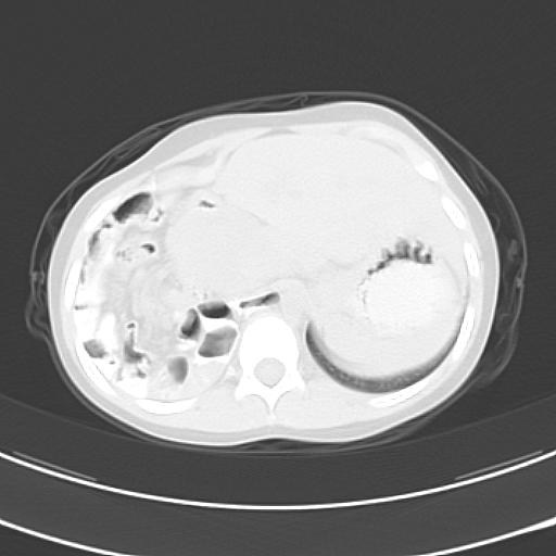 File:Bochdalek diaphragmatic hernia (Radiopaedia 38866-41059 Axial lung window 23).jpg