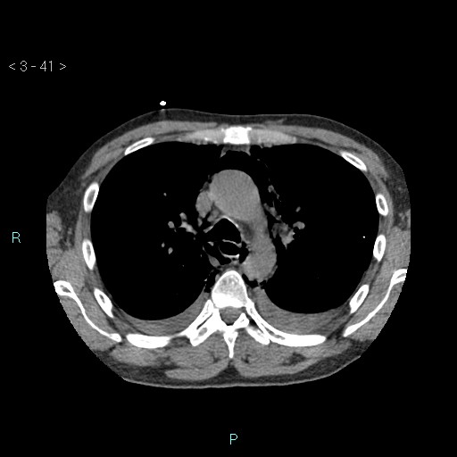 Boerhaave syndrome (Radiopaedia 27683-27897 oral contrast 41).jpg