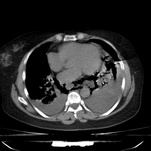 Boerhaave syndrome (Radiopaedia 45644-49799 Axial non-contrast 46).jpg