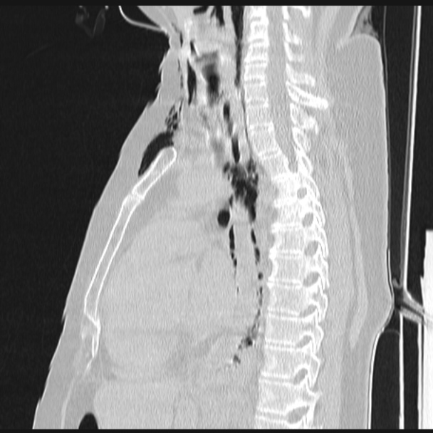 Boerhaave syndrome (Radiopaedia 45644-49799 Sagittal lung window 41).jpg