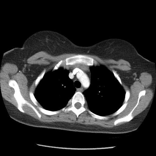 File:Borderline mucinous tumor (ovary) (Radiopaedia 78228-90808 A 13).jpg