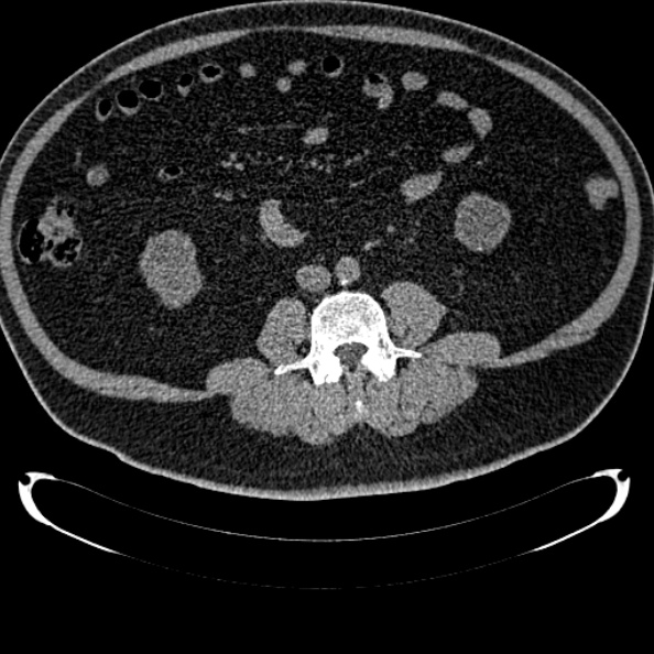 File:Bosniak renal cyst - type IV (Radiopaedia 24244-24518 Axial non-contrast 193).jpg