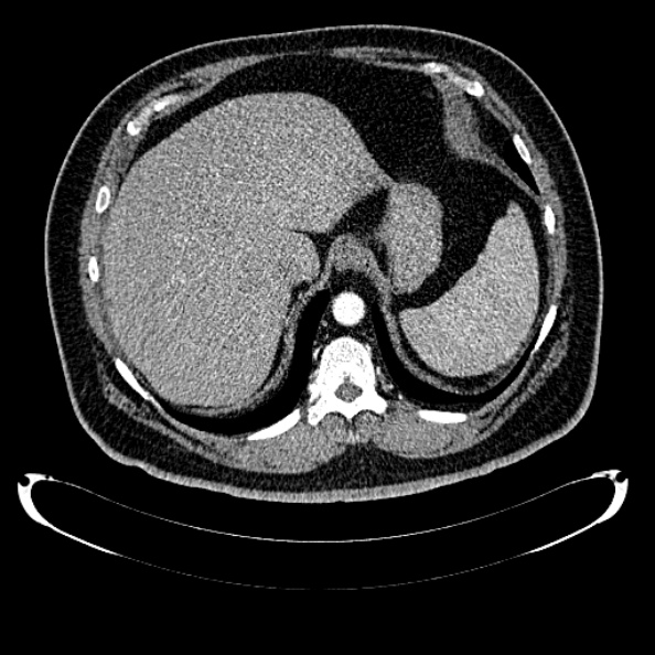 Bosniak renal cyst - type IV (Radiopaedia 24244-24518 B 50).jpg