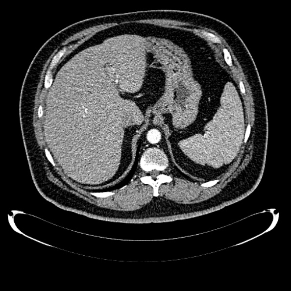 File:Bosniak renal cyst - type IV (Radiopaedia 24244-24518 B 61).jpg