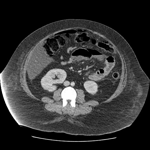 Bowel and splenic infarcts in acute lymphocytic leukemia (Radiopaedia 61055-68915 A 74).jpg