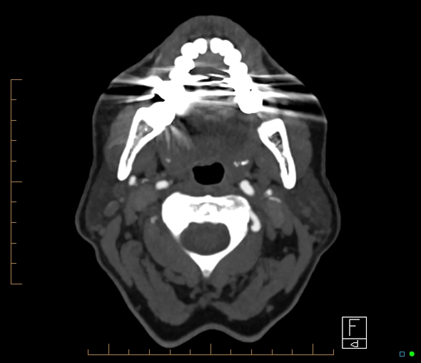 File:Brachiocephalic trunk stenosis (Radiopaedia 87242-103519 A 76).jpg