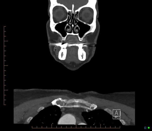 Brachiocephalic trunk stenosis (Radiopaedia 87242-103519 B 11).jpg