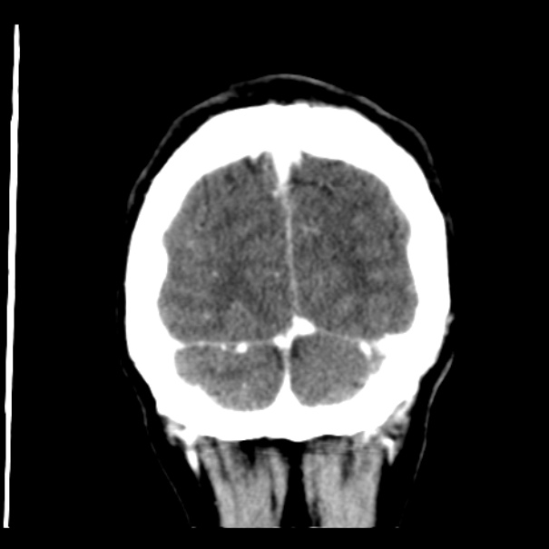 Brain metastases from lung cancer (Radiopaedia 24480-24781 Coronal C+ delayed 56).jpg