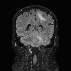 Brain metastases from lung cancer (Radiopaedia 83839-99028 Coronal FLAIR 55).jpg