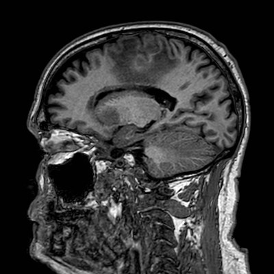 Brain metastases from lung cancer (Radiopaedia 83839-99028 Sagittal T1 81).jpg