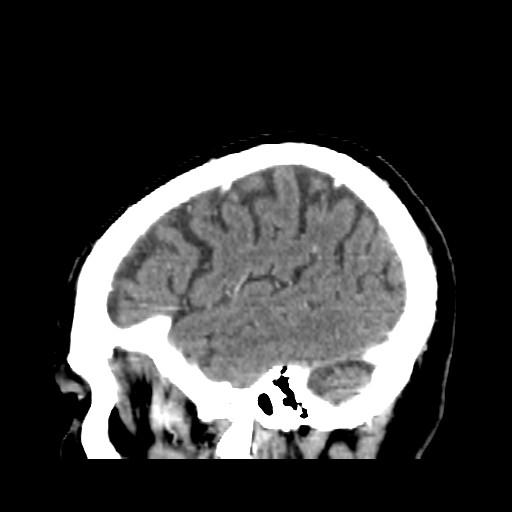Brain metastasis (Radiopaedia 42617-45760 D 6).jpg