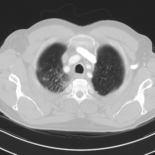 Brain metastasis (large cystic mass) (Radiopaedia 47497-52104 Axial lung window 6).png