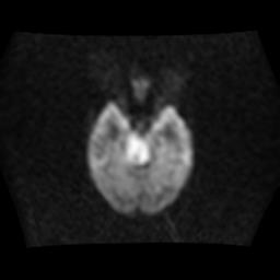 File:Brainstem glioma (Radiopaedia 30923-31624 Axial DWI 7).jpg