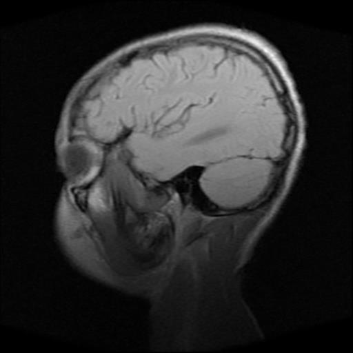File:Brainstem glioma (Radiopaedia 30923-31624 Sagittal T1 4).jpg