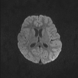 Brainstem glioma (Radiopaedia 67531-76922 Axial DWI 61).jpg