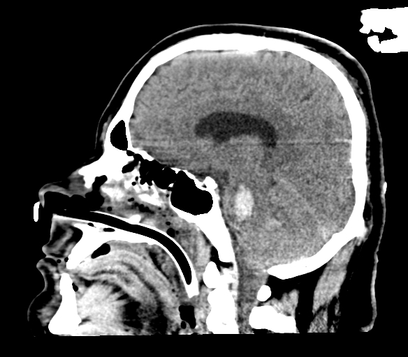 Brainstem hemorrhage (Radiopaedia 81294-94976 C 26).jpg