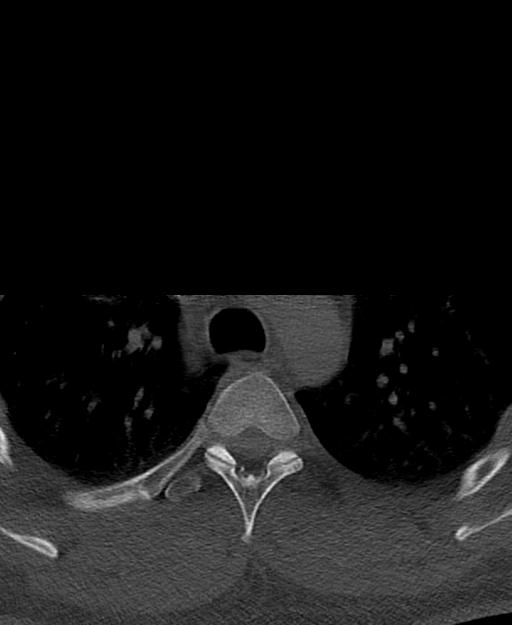 Branchial cleft cyst (Radiopaedia 31167-31875 Axial bone window 86).jpg