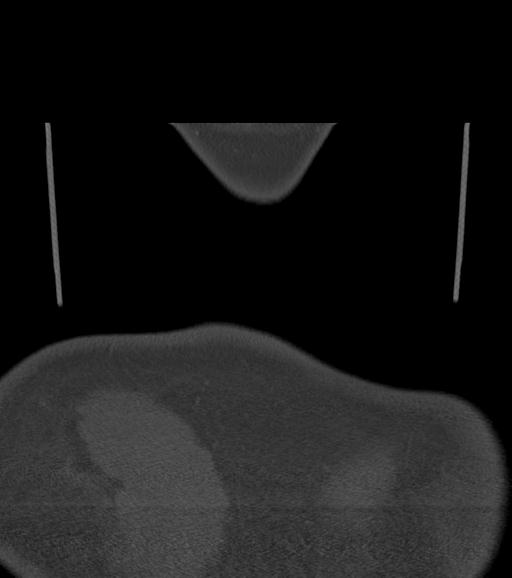 Branchial cleft cyst (Radiopaedia 31167-31875 Coronal bone window 68).jpg
