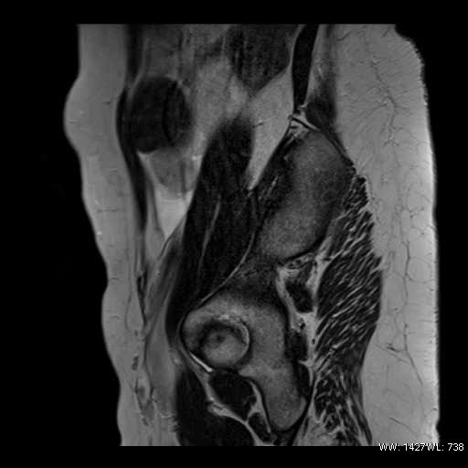 File:Broad ligament fibroid (Radiopaedia 49135-54241 Sagittal T2 3).jpg