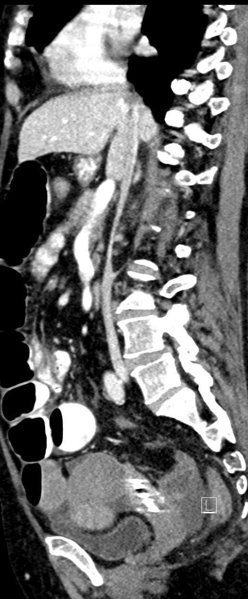 Broad ligament hernia (Radiopaedia 84802-100276 C 44).jpg