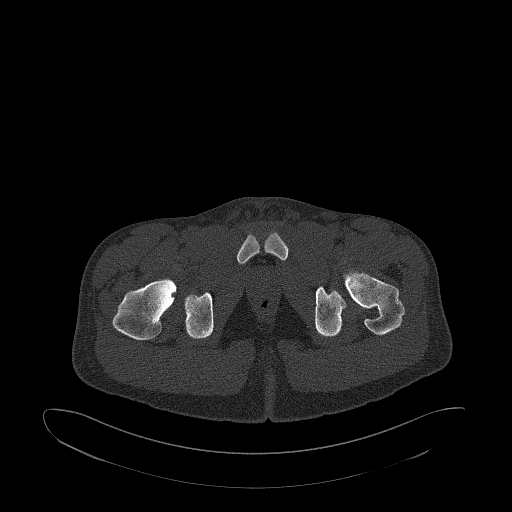 Brodie abscess- femoral neck (Radiopaedia 53862-59966 Axial bone window 181).jpg