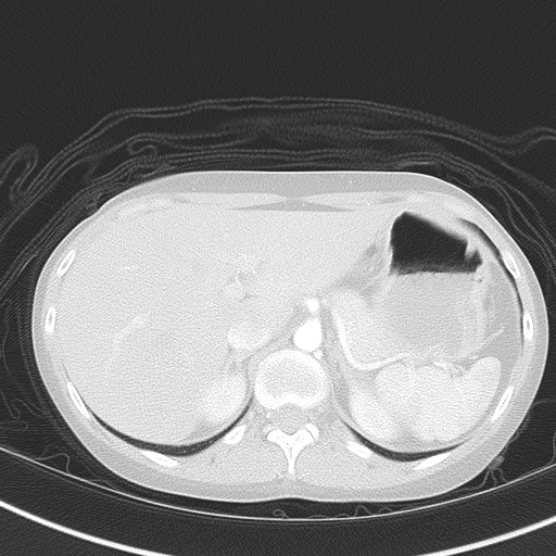Bronchial atresia (Radiopaedia 73677-84470 Axial lung window 56).jpg