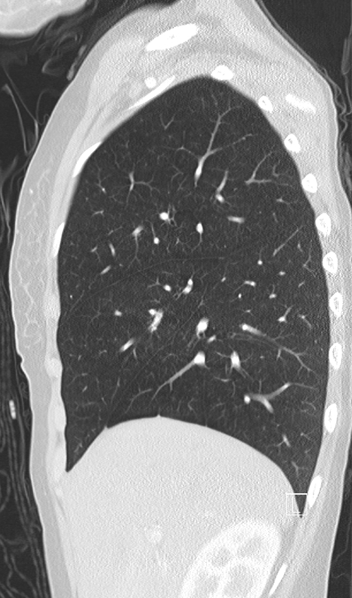 Bronchial atresia (Radiopaedia 73677-84470 Sagittal lung window 15).jpg