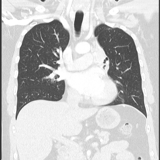 Bronchial carcinoid tumor (Radiopaedia 67377-76764 Coronal lung window 34).jpg