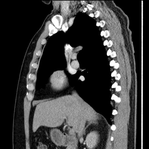 Bronchial carcinoid tumor (Radiopaedia 67377-76764 E 29).jpg