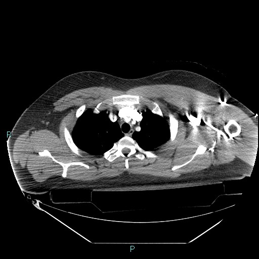 Bronchial carcinoid tumor (Radiopaedia 78272-90870 B 30).jpg