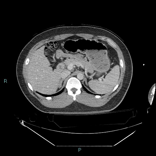 Bronchial carcinoid tumor (Radiopaedia 78272-90870 C 125).jpg