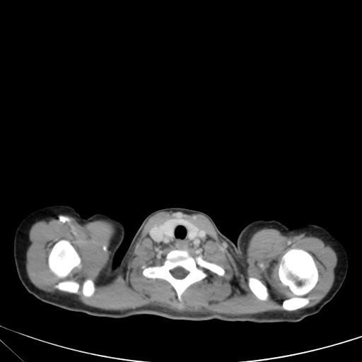 Bronchial mucoepidermoid carcinoma (Radiopaedia 57023-63895 Axial 4).jpg