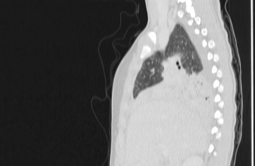 Bronchial mucoepidermoid carcinoma (Radiopaedia 57023-63895 Sagittal lung window 44).jpg
