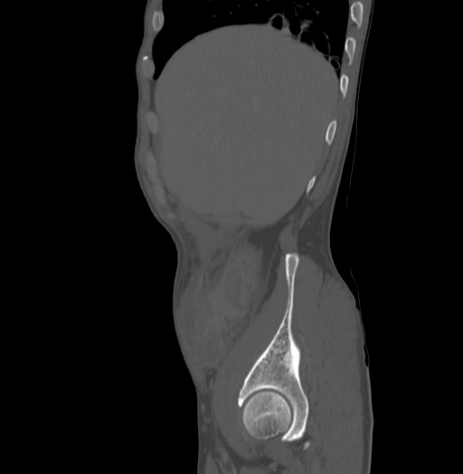 Bronchiectasis in Crohn disease (Radiopaedia 60311-67977 Sagittal bone window 23).jpg