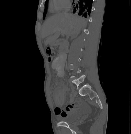 File:Bronchiectasis in Crohn disease (Radiopaedia 60311-67977 Sagittal bone window 88).jpg