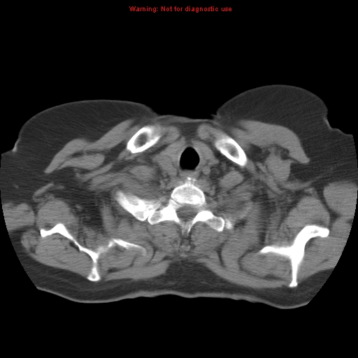 Bronchoalveolar carcinoma (Radiopaedia 13224-13233 Axial non-contrast 4).jpg