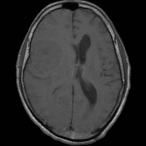 File:Bronchogenic carcinoma brain metastasis (Radiopaedia 9286-9969 Axial T1 1).jpg