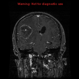 File:Bronchogenic carcinoma brain metastasis (Radiopaedia 9286-9969 Coronal T1 14).jpg