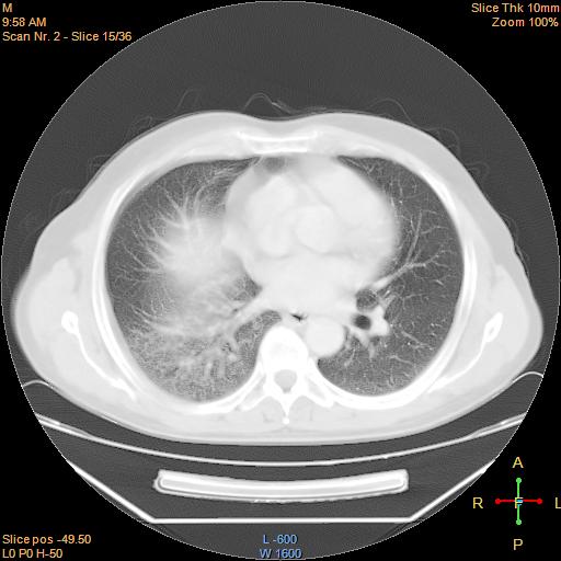 File:Bronchogenic carcinoma with superior vena caval invasion (Radiopaedia 22378-22406 lung window 12).jpg