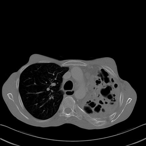 File:Bronchopleural fistula secondary to tuberculosis (Radiopaedia 20415-20322 Axial bone window 11).jpg