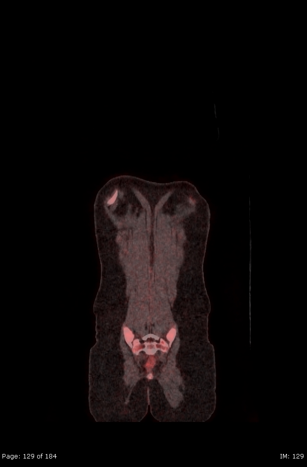 Brown fat uptake (FDG PET-CT) (Radiopaedia 77392-89513 Fused coronal 87).jpg