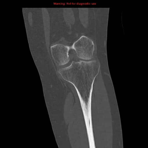 File:Brown tumors (Radiopaedia 9666-10291 Coronal bone window 19).jpg