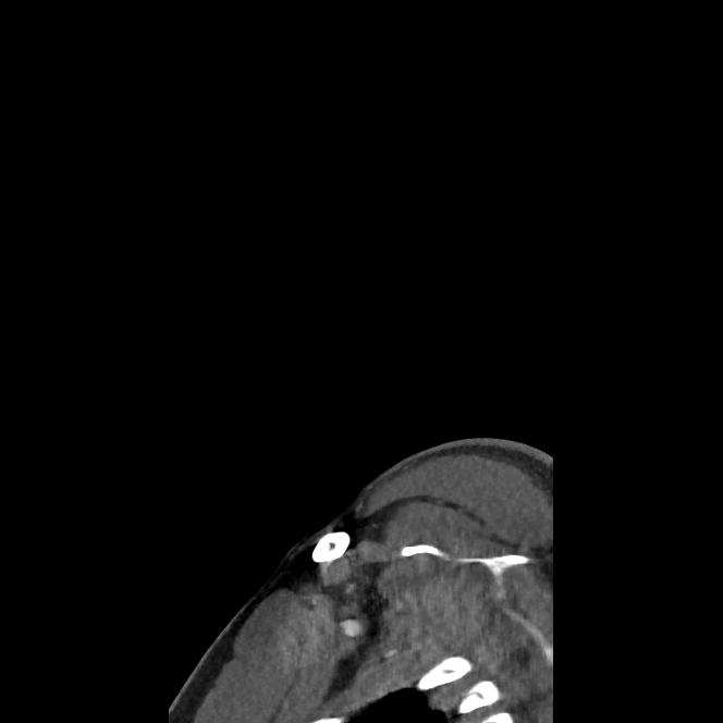 Buccal fat pad arteriovenous malformation (Radiopaedia 70936-81144 C 10).jpg