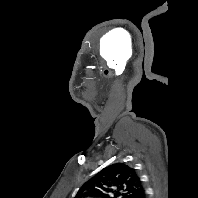 Buccal fat pad arteriovenous malformation (Radiopaedia 70936-81144 C 24).jpg