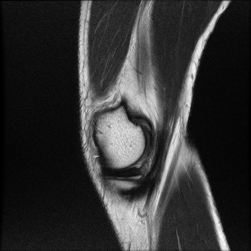 File:Bucket-handle meniscus tear (Radiopaedia 65700-74809 Sagittal T2 4).jpg