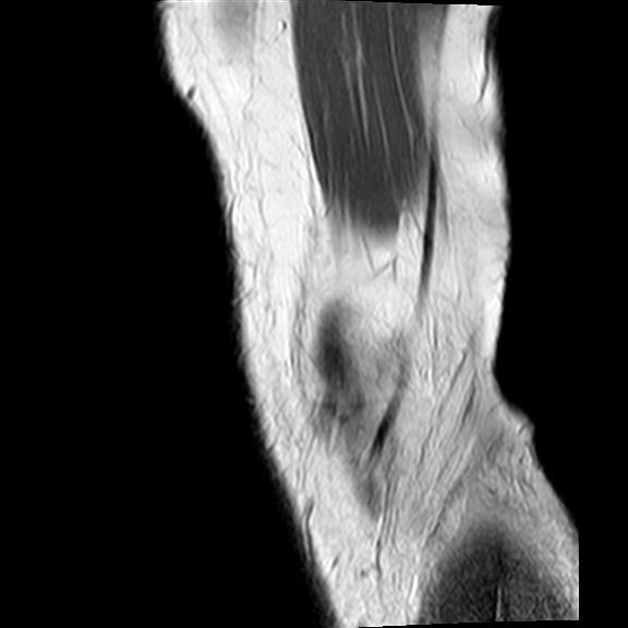File:Bucket handle tear - medial meniscus (Radiopaedia 29250-29664 Sagittal PD 22).jpg