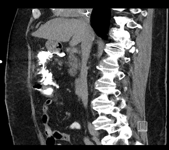 Buried bumper syndrome - gastrostomy tube (Radiopaedia 63843-72577 Sagittal Inject 69).jpg